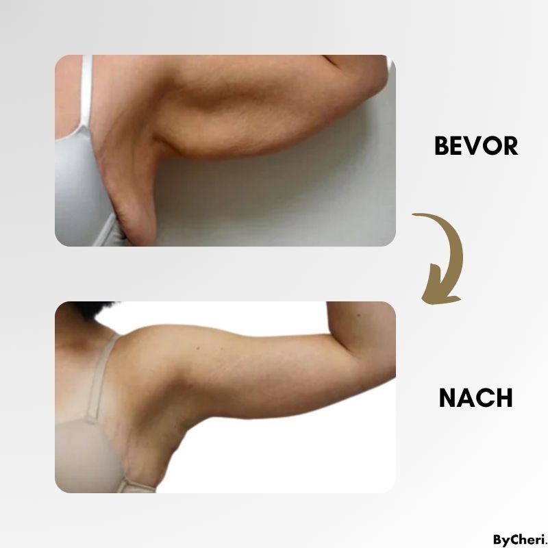 LymphWave™ Paket Hartnäckiges Fett mit lymphatischer Stimulation