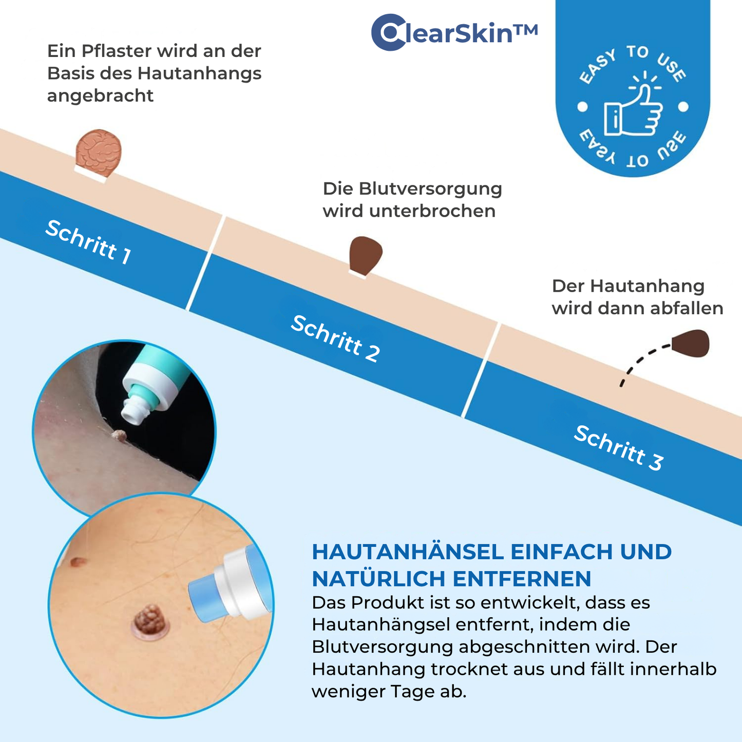 TagRelease™ - Schmerzfreie Hautanhängsel-Entfernung zu Hause