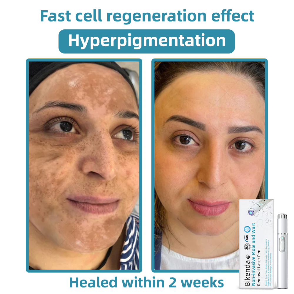 LaserPro™ - Professionelle Hautperfektion zu Hause