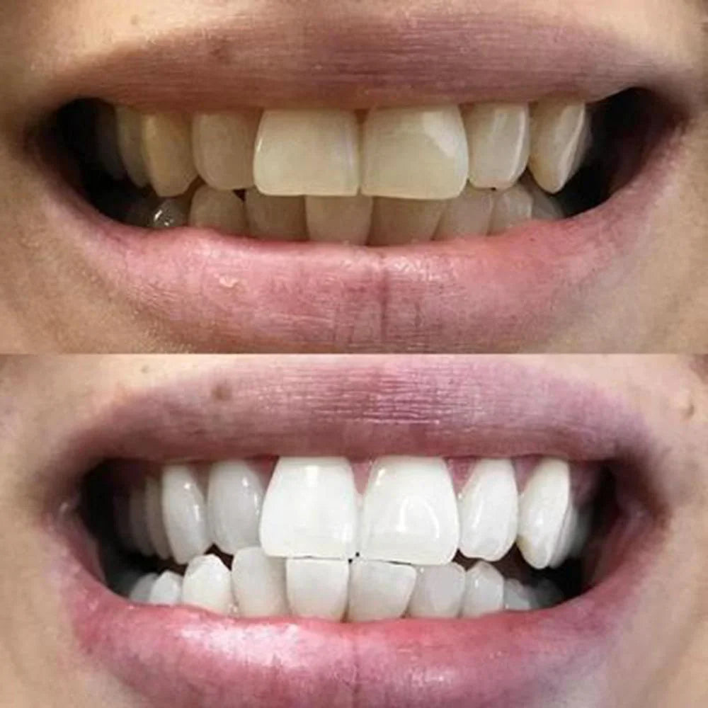 WhiteStrips™ - Weißere Zähne ohne Verrutschen oder Schmerzen