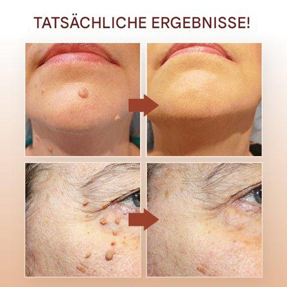 SkinClear™ - Natürliche Warzenentfernung ohne Schmerzen