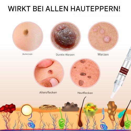 SkinClear™ - Natürliche Warzenentfernung ohne Schmerzen