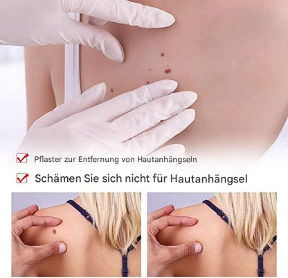 SkinClear™ - Natürliche Warzenentfernung ohne Schmerzen