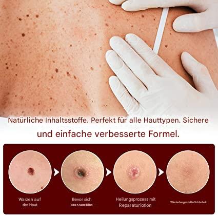 SkinClear™ - Natürliche Warzenentfernung ohne Schmerzen