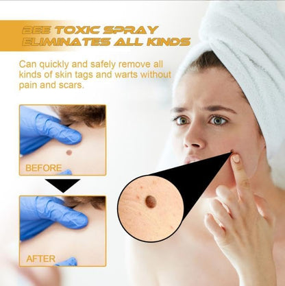 ClearSkin™ - Sanfte Warzen- & Hautanhängsel-Entfernung