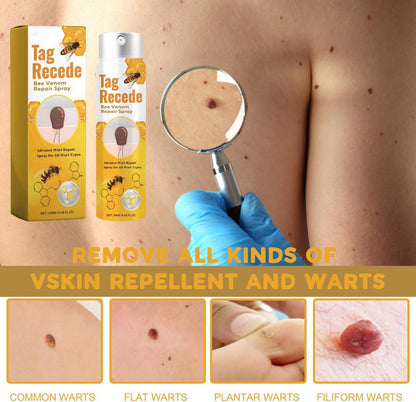 ClearSkin™ - Sanfte Warzen- & Hautanhängsel-Entfernung