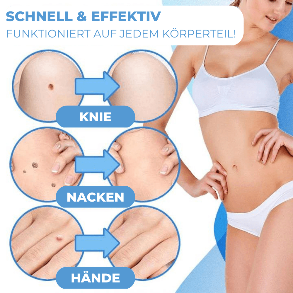 BandAway™ - Schmerzfreies Hautanhängsel-Entfernungs-Set