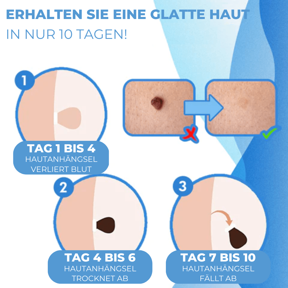BandAway™ - Schmerzfreies Hautanhängsel-Entfernungs-Set